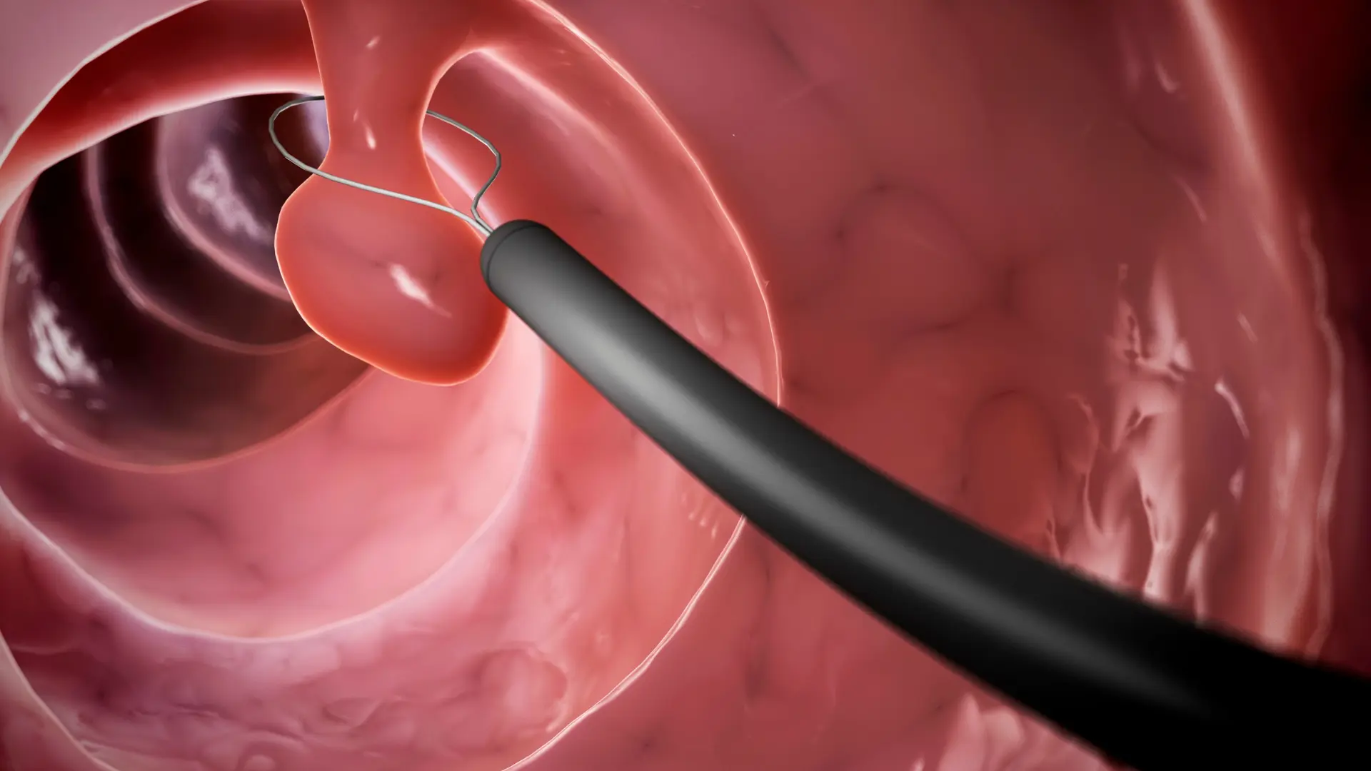 Digestive Tract Biopsy